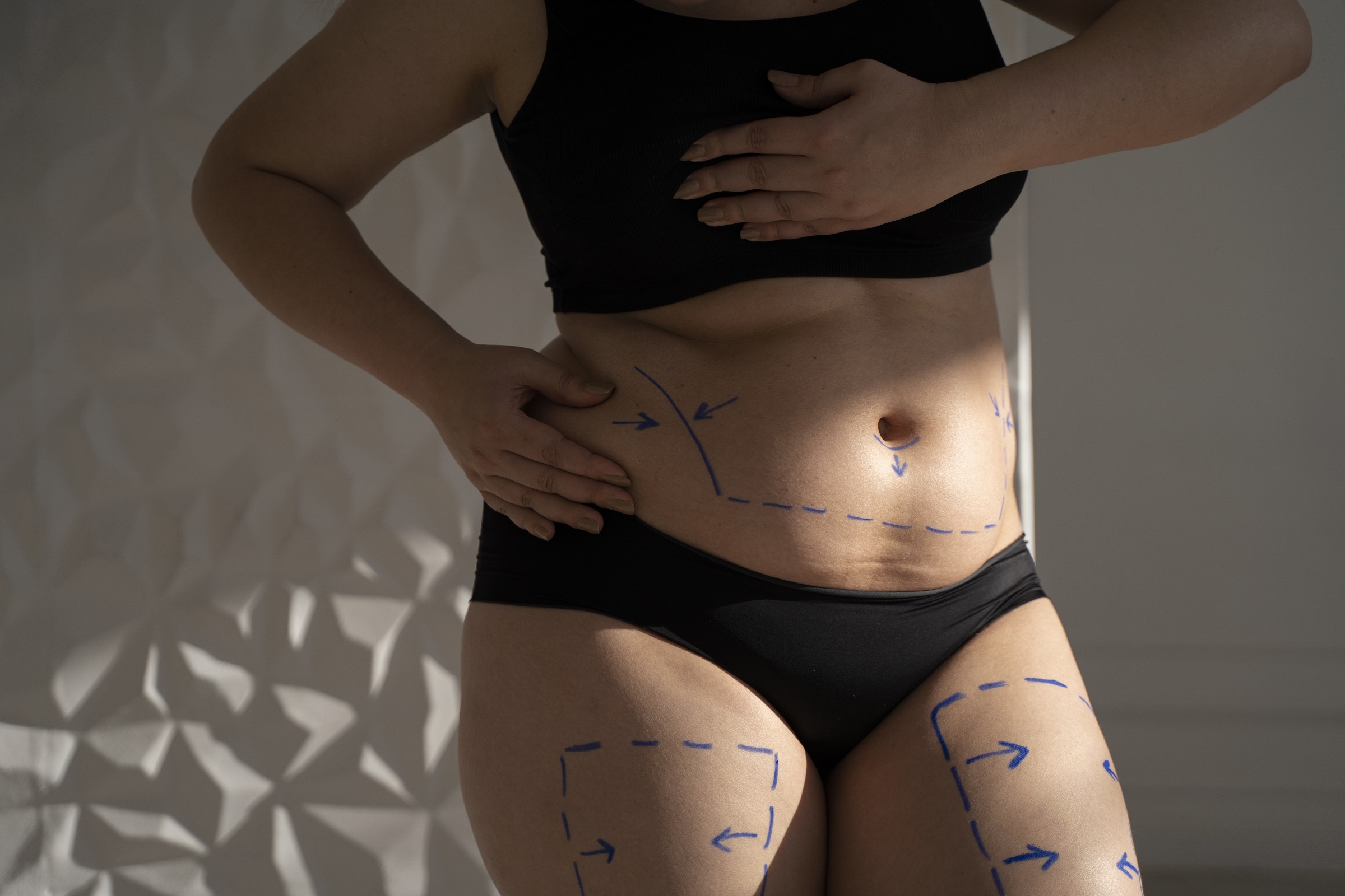 Miniabdominoplastia e lipoaspiração